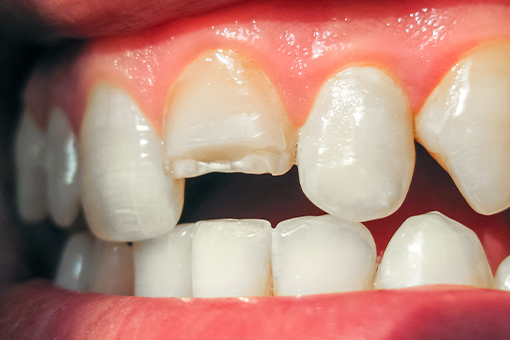 CEREC-Same-Day-Crowns-Temp-1-1
