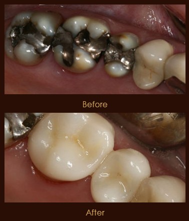 CEREC Same Day Crowns Temp 3
