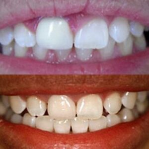 Teeth of Wesley Chapel Man Before and After Gummy Smile Correction Treatment
