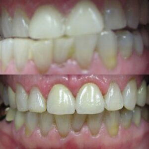 Teeth Before and After Wesley Chapel Dentis Corrected Gummy Smile