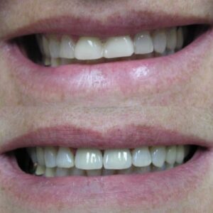 Before and After Gummy Smile Correction in Wesley Chapel Florida