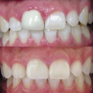 Comparison Before and After Correcting Gummy Smile in Wesley Chapel FL