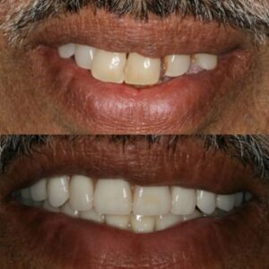 Comparison of Teeth of Wesley Chapel Florida Man With and Without Dentures