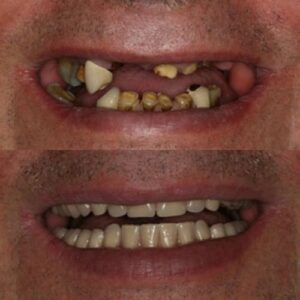 Image Without Dentures and With Dentures Created by Wesley Chapel Dentist