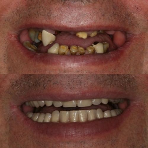 Image Without Dentures and With Dentures Created by Wesley Chapel Dentist