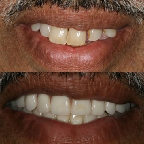 Comparison of Teeth of Wesley Chapel Florida Man With and Without Dentures