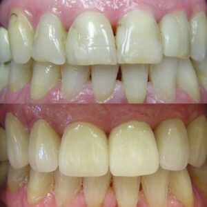 Before and After Getting Front Teeth Crowns From Dental Clinic in Wesley Chapel FL