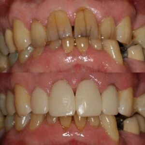 Teeth of Wesley Chapel Resident Before and After Getting Front Teeth Crowns