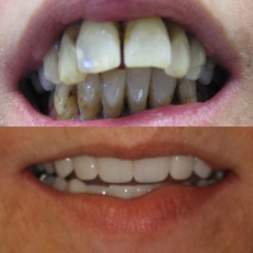Amazing Transformation Before and After Full Dental Reconstruction in Wesley Chapel Florida