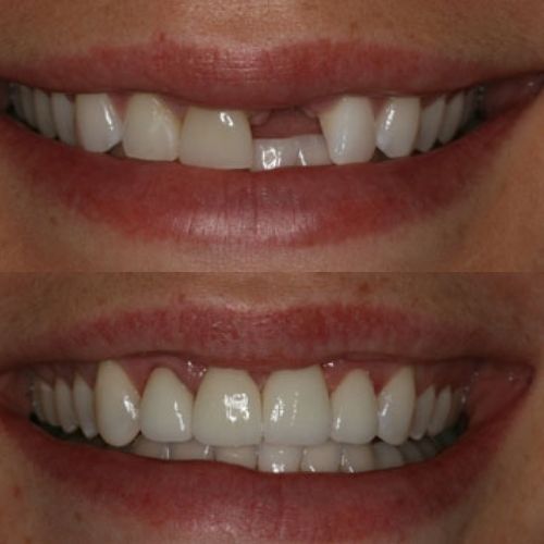 Teeth of Wesley Chapel Florida Lady Before and After Getting Implants and Crowns