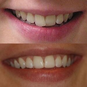 Lady From Wesley Chapel Florida Smiling With and Without Invisalign