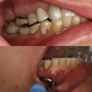 Teeth of Wesley Chapel Patient Before and After Laser Dentistry Treatment