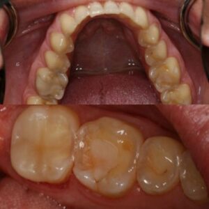 Comparison Before and After Onlays Treatment in Wesley Chapel FL