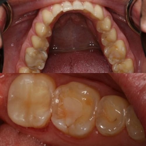 Comparison Before and After Onlays Treatment in Wesley Chapel FL