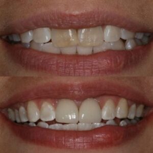 Before and After Wesley Chapel Dentist Placed Porcelain Crowns