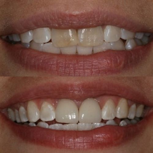 Before and After Wesley Chapel Dentist Placed Porcelain Crowns