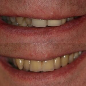 Huge Difference in Smile of Wesley Chapel Guy Before and After Getting Porcelain Crowns