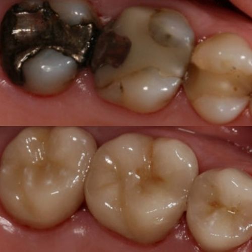 Teeth of Wesley Chapel Patient Before and After Porcelain Crowns Treatment in Wesley Chapel FL