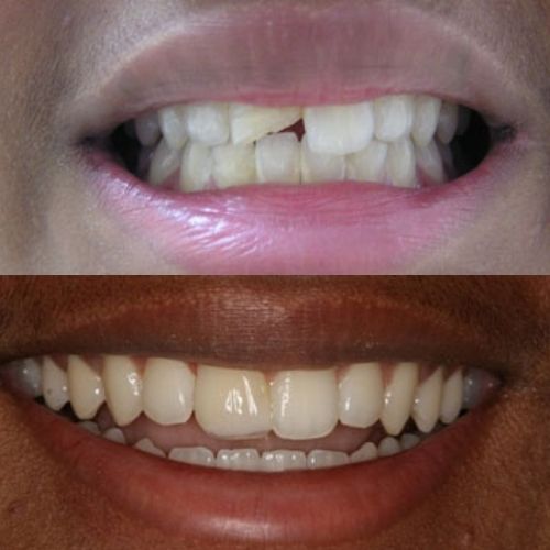 Comparison Before and After Repairing Broken Teeth at a Dental Clinic in Wesley Chapel FL