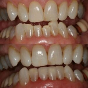 Images Before and After Restoring Teeth of Wesley Chapel Florida Man