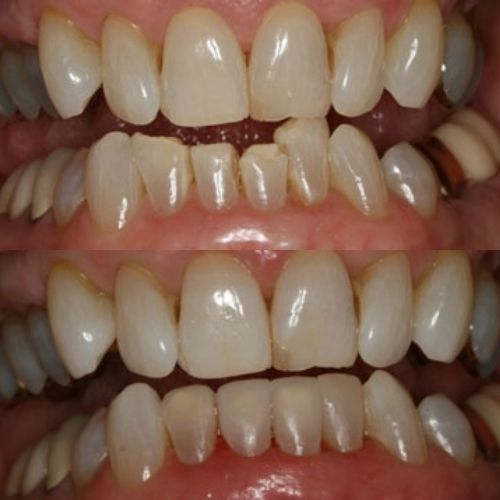 Images Before and After Restoring Teeth of Wesley Chapel Florida Man