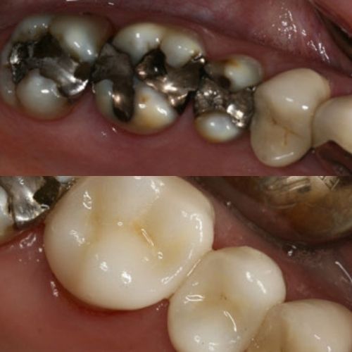 Silver Filling vs Porcelain Same Day Crown at Wesley Chapel Dentistry