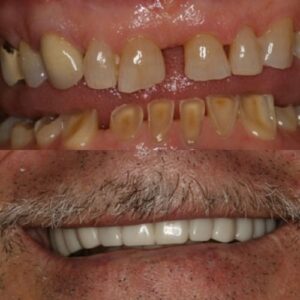 Unbelievable Difference in Smile of Wesley Chapel FL Man Before and After Smile Makeover