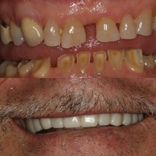 Unbelievable Difference in Smile of Wesley Chapel FL Man Before and After Smile Makeover