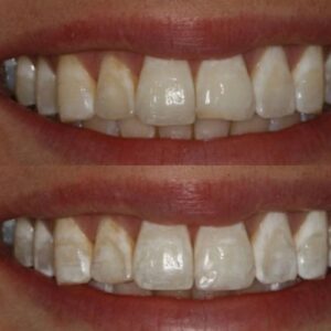 Teeth of Wesley Chapel Patient Before and After Tooth-Colored Fillings Treatment