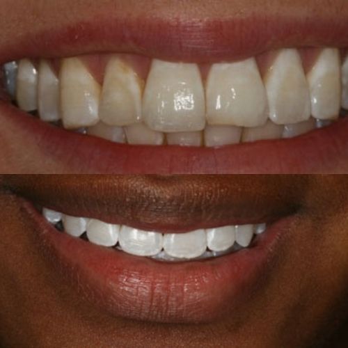 Comparison Before and After Zoom Whitening in Wesley Chapel