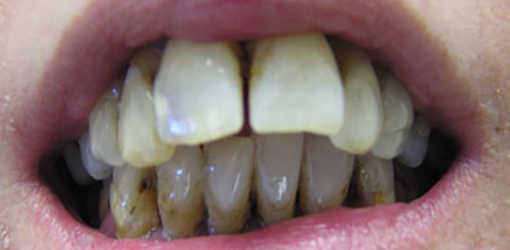 Teeth of Wesley Chapel Lady Before Visiting Dentist for Comprehensive Rehabilitation