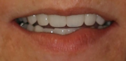 Wesley Chapel Lady's Teeth After Getting Comprehensive Dental Rehabilitation Services