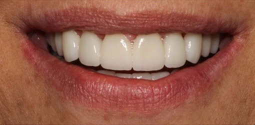 CEREC Same-day Dental Crown Placed to by Wesley Chapel FL Dentist