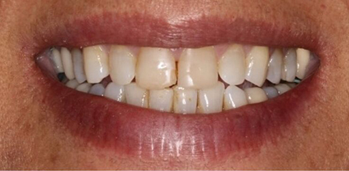Teeth with Spaces Before Wesley Chapel Woman Got Dental Crowns