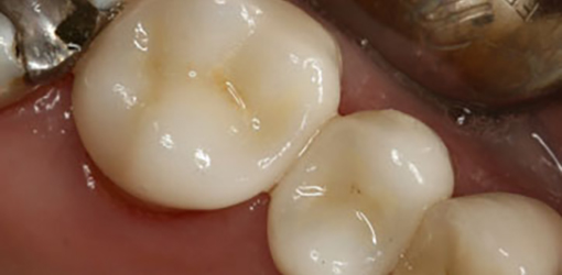 CEREC Dental Crowns Installed On the Same Day to Patient Visiting Wesley Chapel Dentist