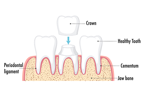 Vector Showing How Wesley Chapel Dentist Puts Dental Crowns