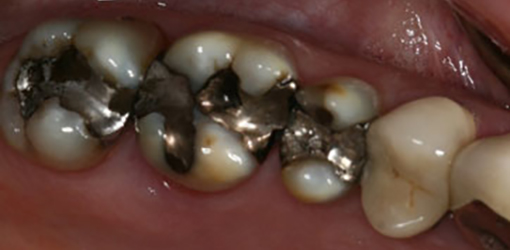 Silver-colored Dental Crown of a Wesley Chapel Lady