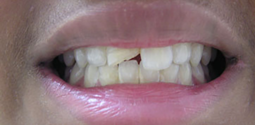 Photo Before Fixing Teeth of Man with Chipped Tooth in Wesley Chapel Florida