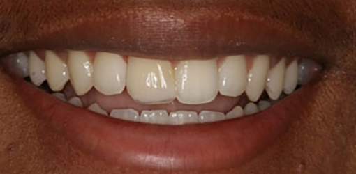 Teeth of Wesley Chapel Man After Getting It Fixed