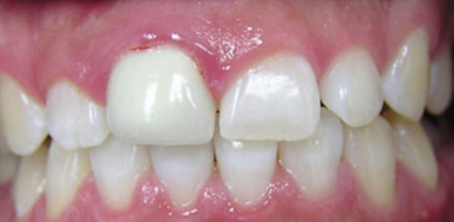 Teeth of Wesley Chapel Lady Before Gummy Smile Correction