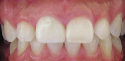 Teeth of Wesley Chapel Lady After Visiting Dentist For Gummy Smile Correction