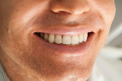 Wide Smile of a Wesley Chapel Man Who Just Got His Implant Bridges