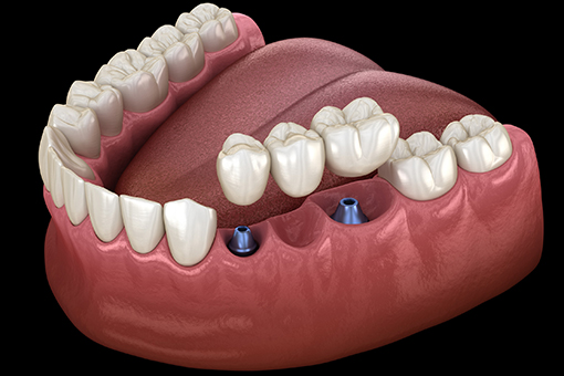 3D Render of How Implant Bridges Are Installed by Wesley Chapel Dentist