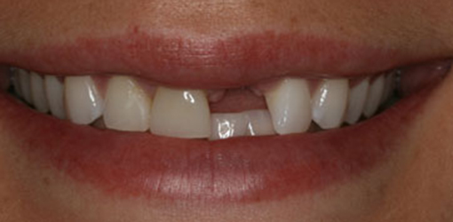 Wesley Chapel Lady's Teeth In Need of Implant Dentistry