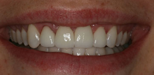 Teeth of Wesley Chapel Woman After Getting Implant Dentistry Services