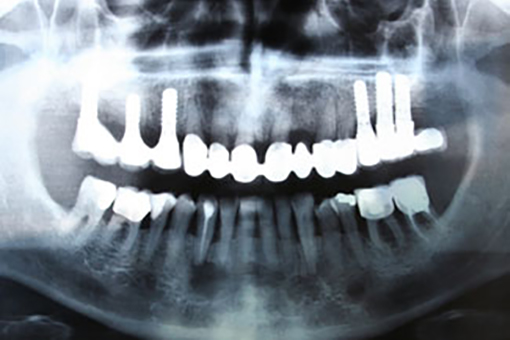 Panoramic Xray of Wesley Chapel Man's Teeth In Need of Implant Dentistry Services