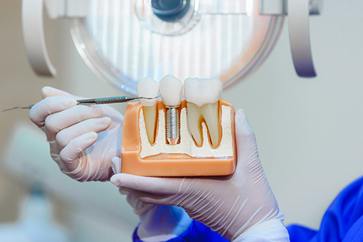 Wesley Chapel Dentist Using a Model To Explain How Implant Dentistry Works