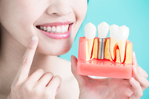 Wesley Chapel Lady Smiling While Showing 3D Model of Her Implant Smile Replacement