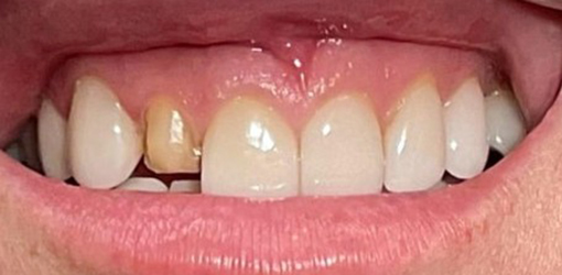 Image Before Implant Smile Replacement in Wesley Chapel Florida