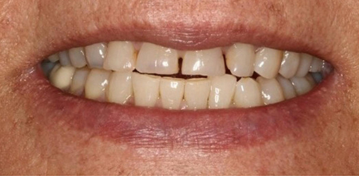 Teeth of Wesley Chapel Man Before Availing Implant Smile Replacement Services